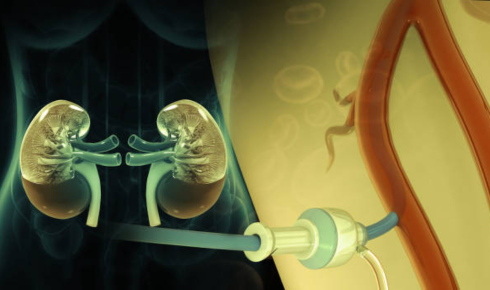 Kidney Transplant In bangalore